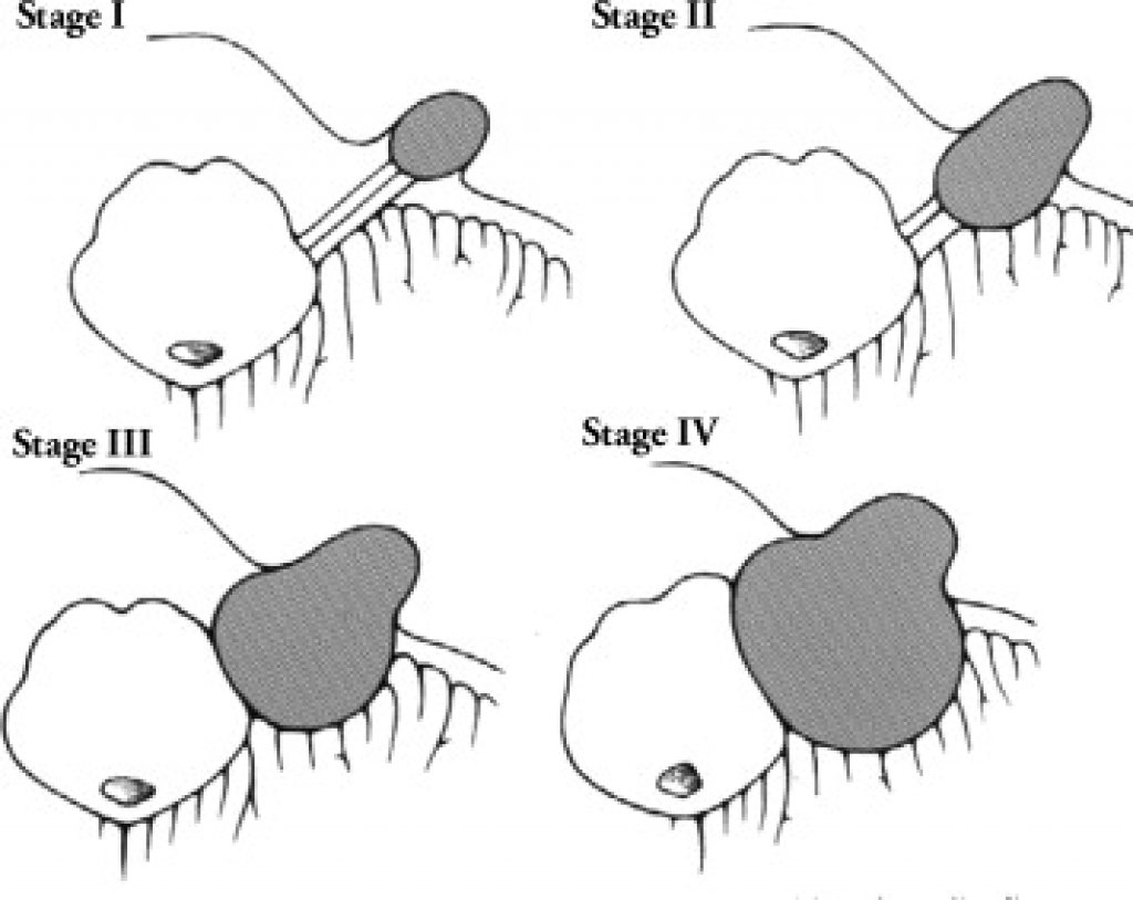 Невринома слухового нерва (вестибулярная шваннома); классификации KOOS, SAMII