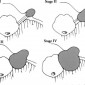 Невринома слухового нерва (вестибулярная шваннома); классификация KOOS классификация KOOS