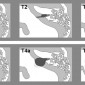 Невринома слухового нерва (вестибулярная шваннома); классификация M. Samii Невринома слухового нерва (вестибулярная шваннома); классификации KOOS, SAMII. 