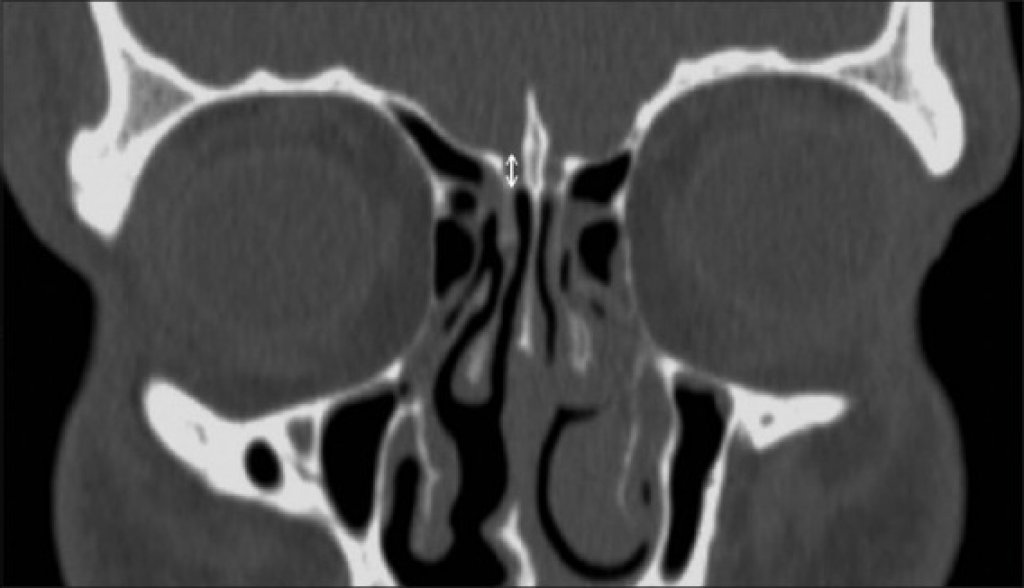 Латеропозиция средней носовой раковины. Носовые раковины на кт анатомия. Гипоплазия средней носовой раковины.