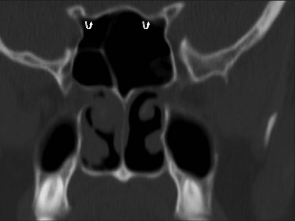 Парадоксальный изгиб средней носовой раковины. Парадоксальный изгиб средних носовых раковин кт. Латеропозиция носовых раковин. Верхние носовые раковины на кт.