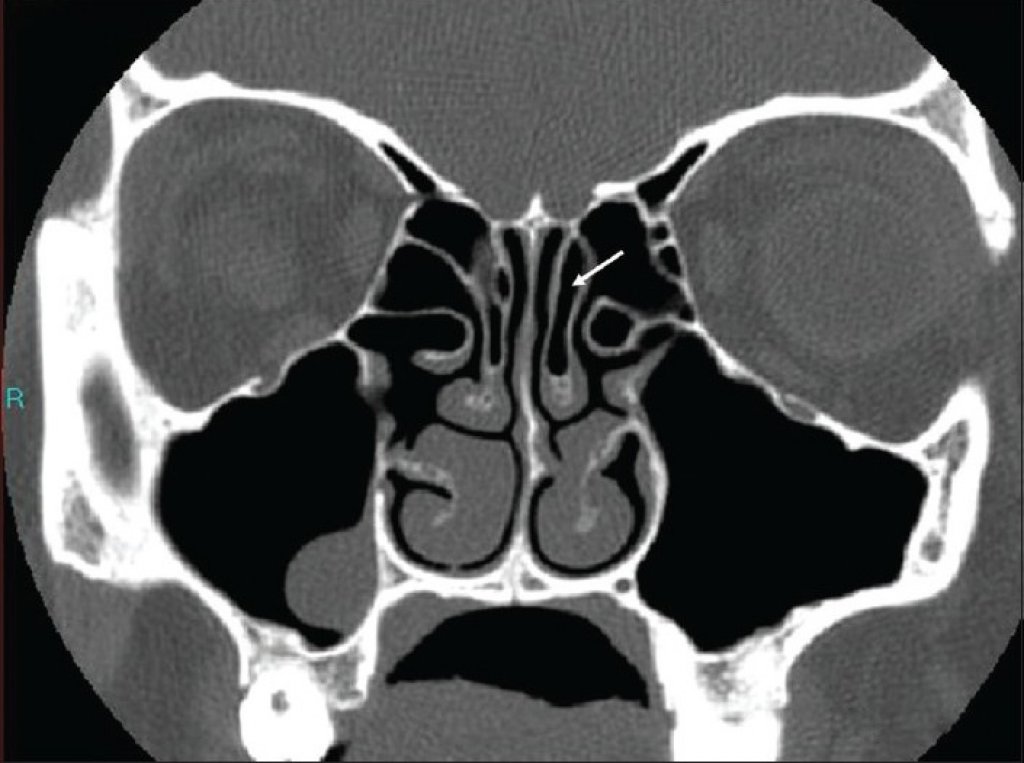 Конхобуллез средней носовой раковины. Носовые раковины на кт анатомия. Concha Bullosa средней носовой раковины кт. Верхние носовые раковины на кт.