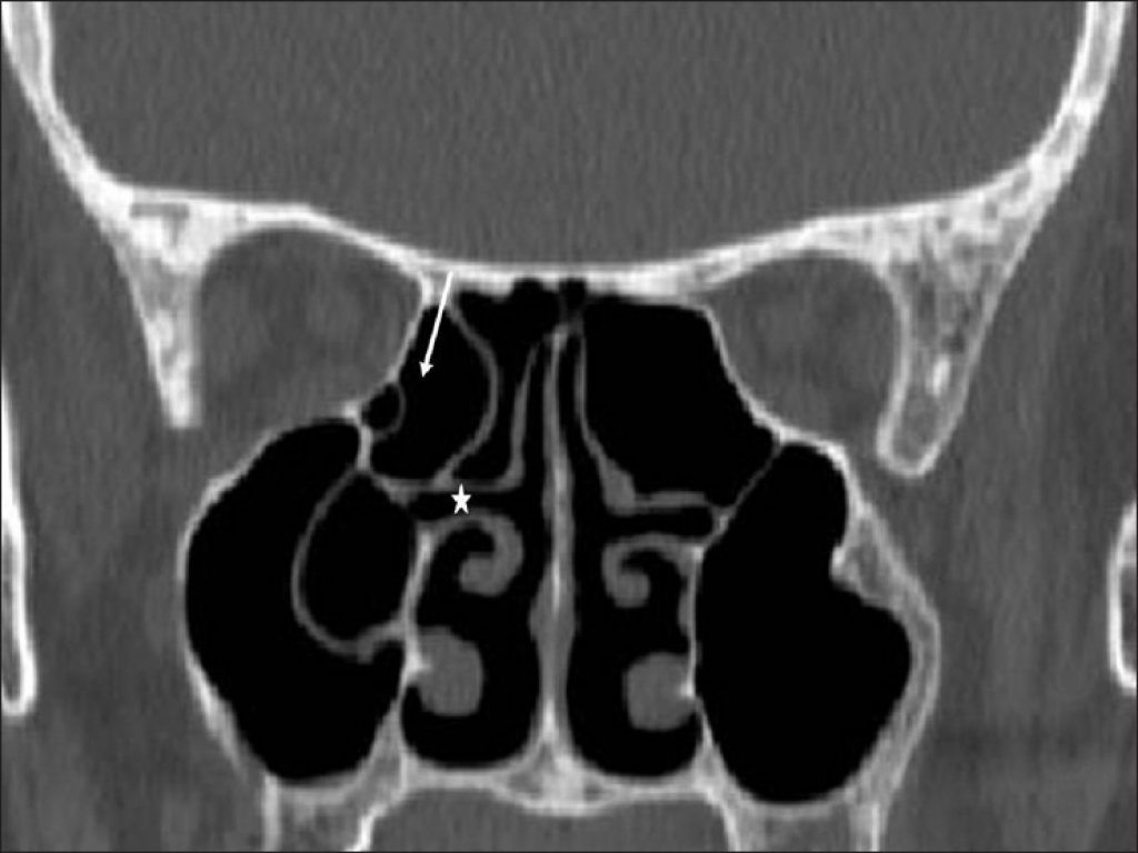 Конхобуллез средней носовой раковины. Парадоксальный изгиб средних носовых раковин кт.