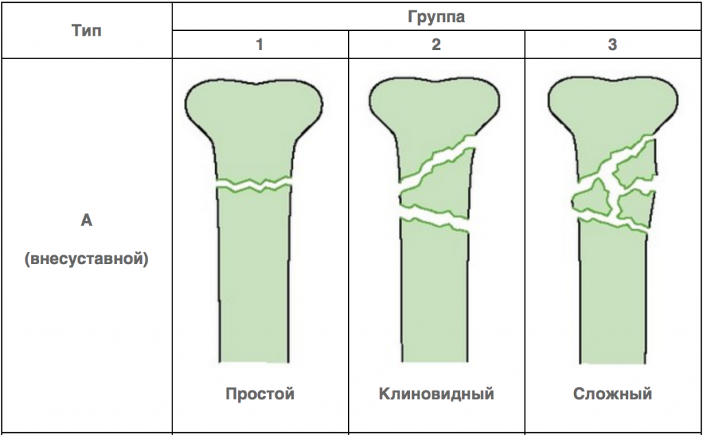 1 тип перелома. Классификация переломов АО/Asif. Классификация переломов ao/Asif. Классификация переломов AOVET. Классификация АО переломов диафиза большеберцовой кости.