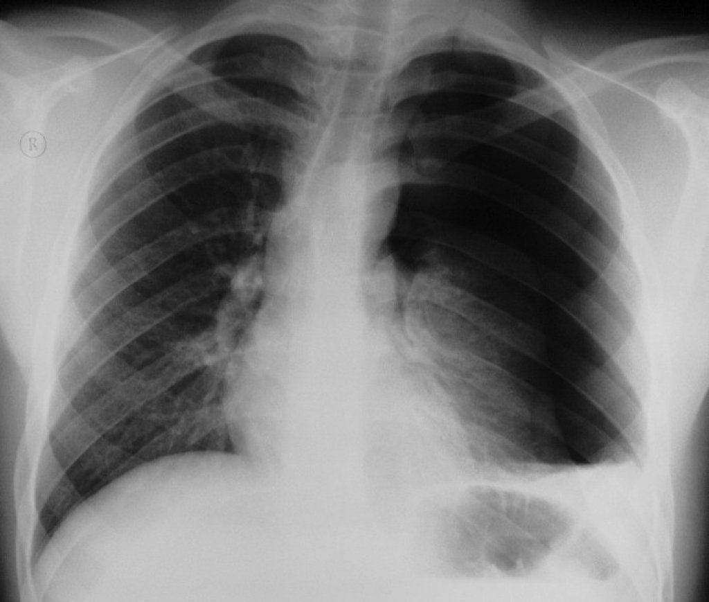 Пневмогидроторакс с коллапсом лёгкого