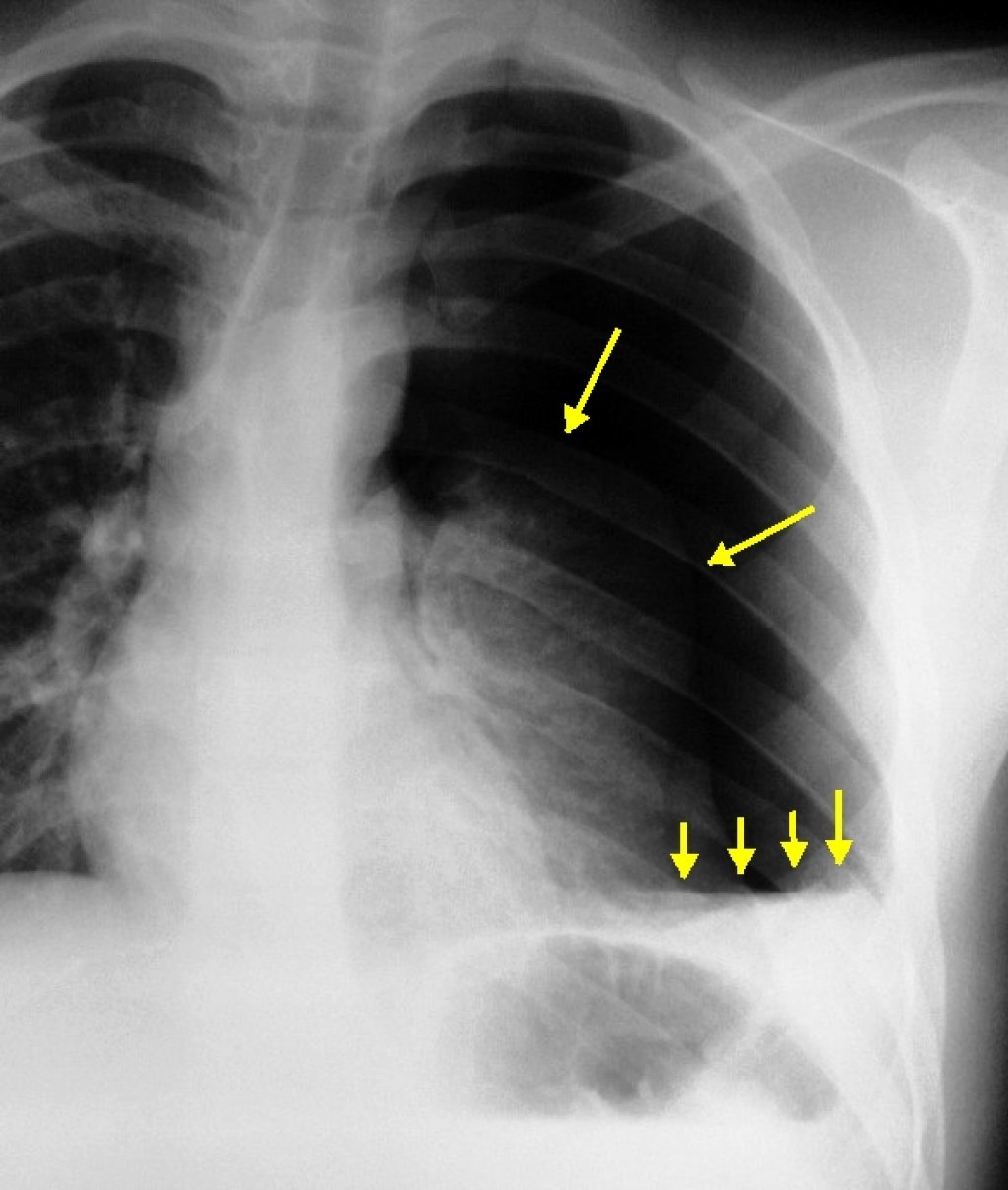 Пневмоторакс на рентгене фото