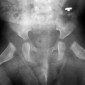 Врожденная дисплазия тазобедренного сустава Врожденный подвывих справа