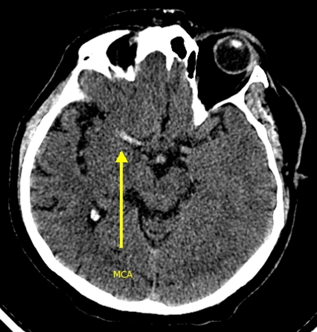 Тромбоз мозга. Тромбоз артерий головного мозга на кт. Тромбоз сосудов головного мозга на кт. Тромбоз СМА на кт. Тромбоз средней мозговой артерии.