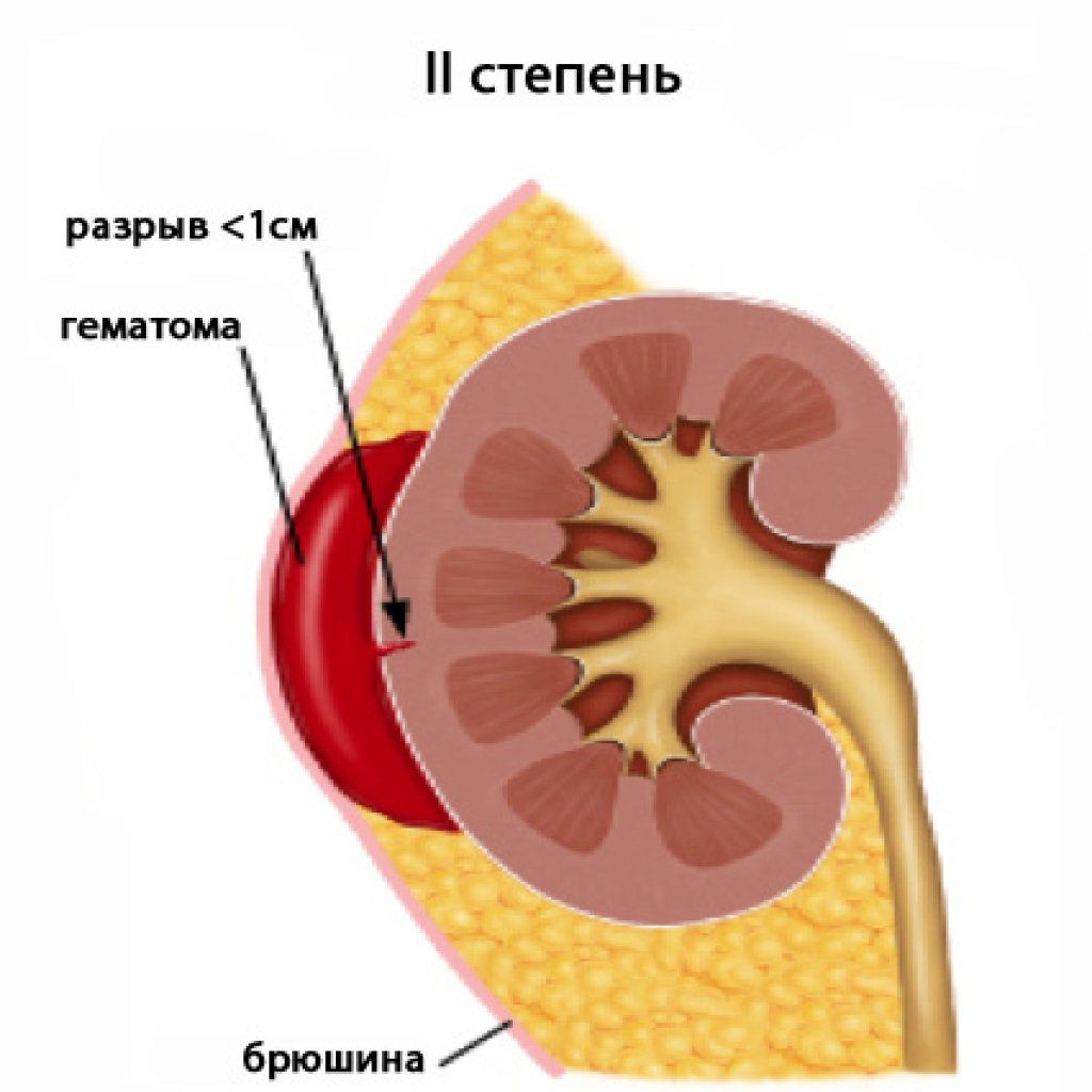 Травма почки