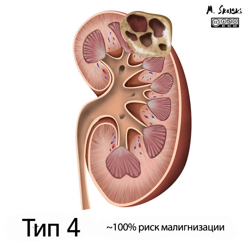 Киста почки классификация по Bosniak
