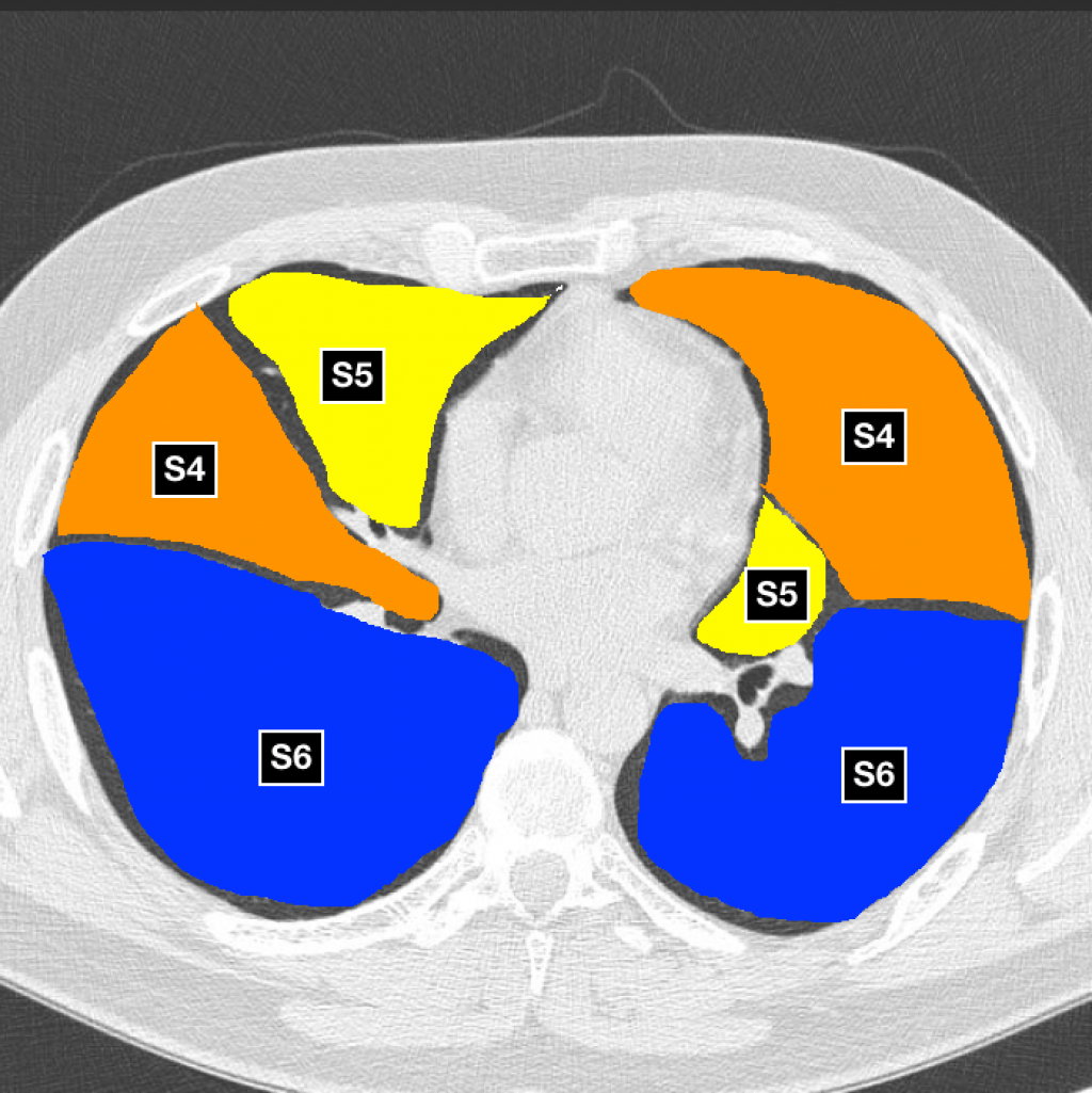 Анатомия легких: сегменты на рентгенограмме и КТ