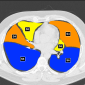 Анатомия легких: сегменты на рентгенограмме и КТ Сегменты легких при компьютерной томографии