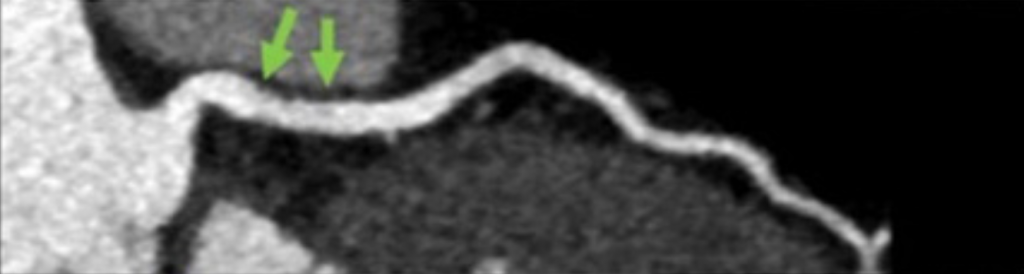 Coronary Artery Disease - Reporting and Data System (CAD-RADS) Coronary Artery Disease - Reporting and Data System (CAD-RADS)