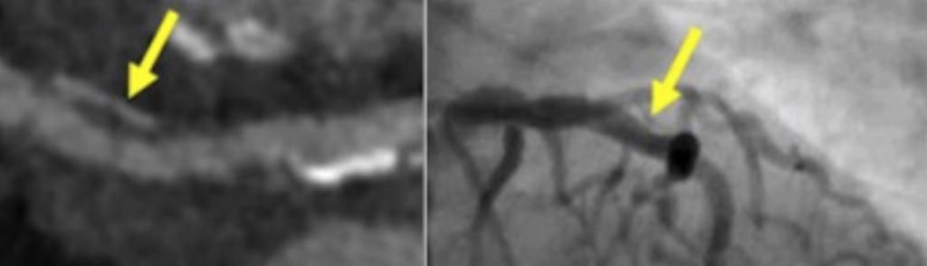 Coronary Artery Disease - Reporting and Data System (CAD-RADS) Coronary Artery Disease - Reporting and Data System (CAD-RADS)