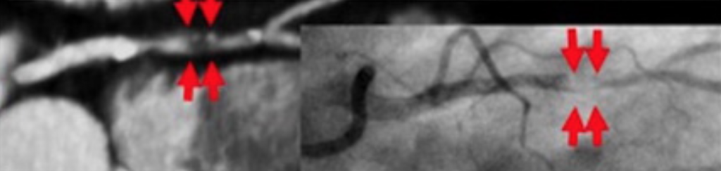 Coronary Artery Disease - Reporting and Data System (CAD-RADS) Coronary Artery Disease - Reporting and Data System (CAD-RADS)