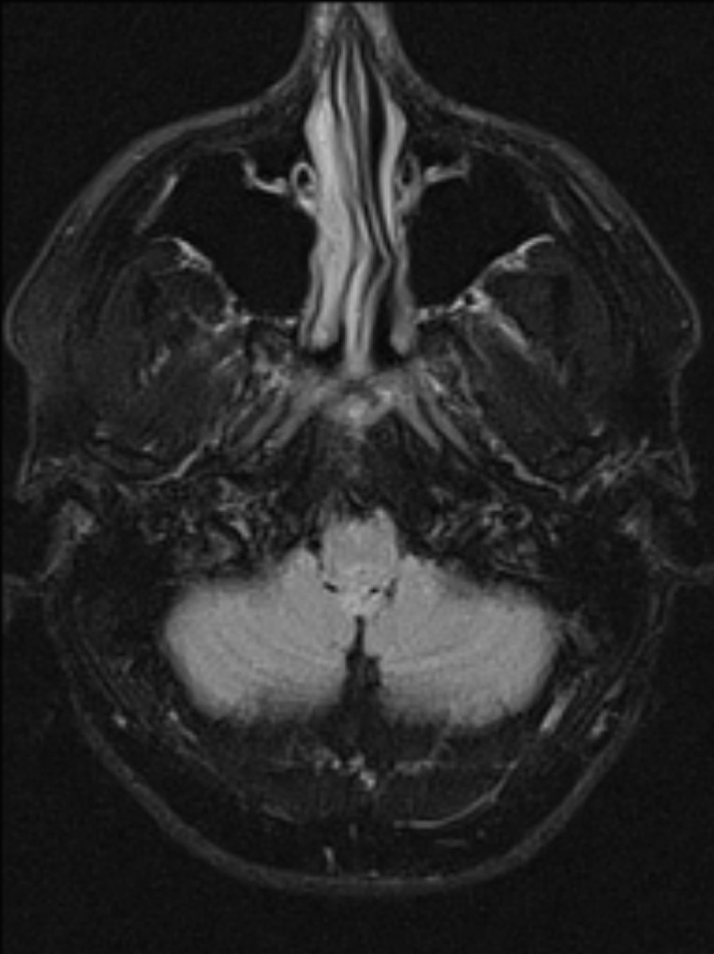 Субэпендимома IV-го желудочка (Subependymoma - fourth ventricle)