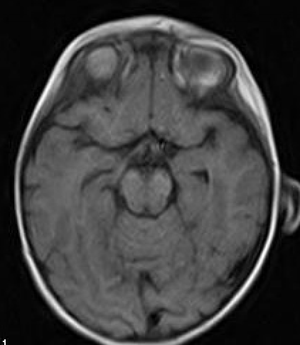 Пантотенат киназа-ассоциированная нейродегенерация (болезнь Галлервордена-Шпатца)