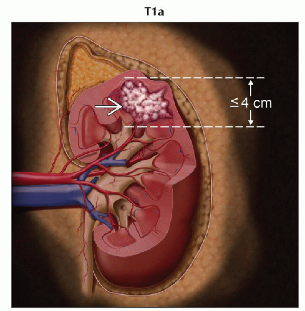 Почечно-клеточный рак (стадирование TNM)