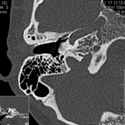 Kohlearnyj Otoskleroz Radiografiya