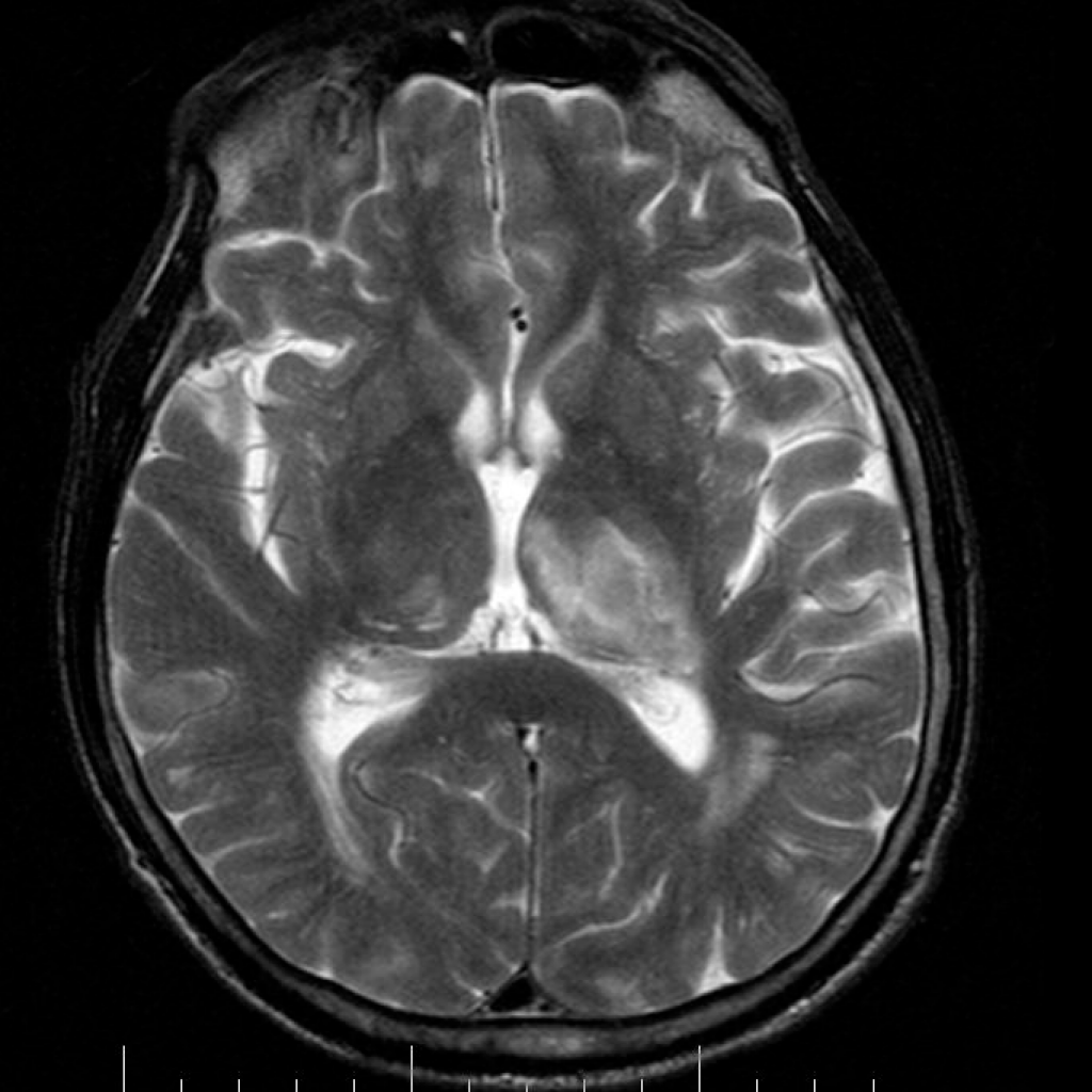 Инсульт головного мозга в бассейне задних соединительных артерий