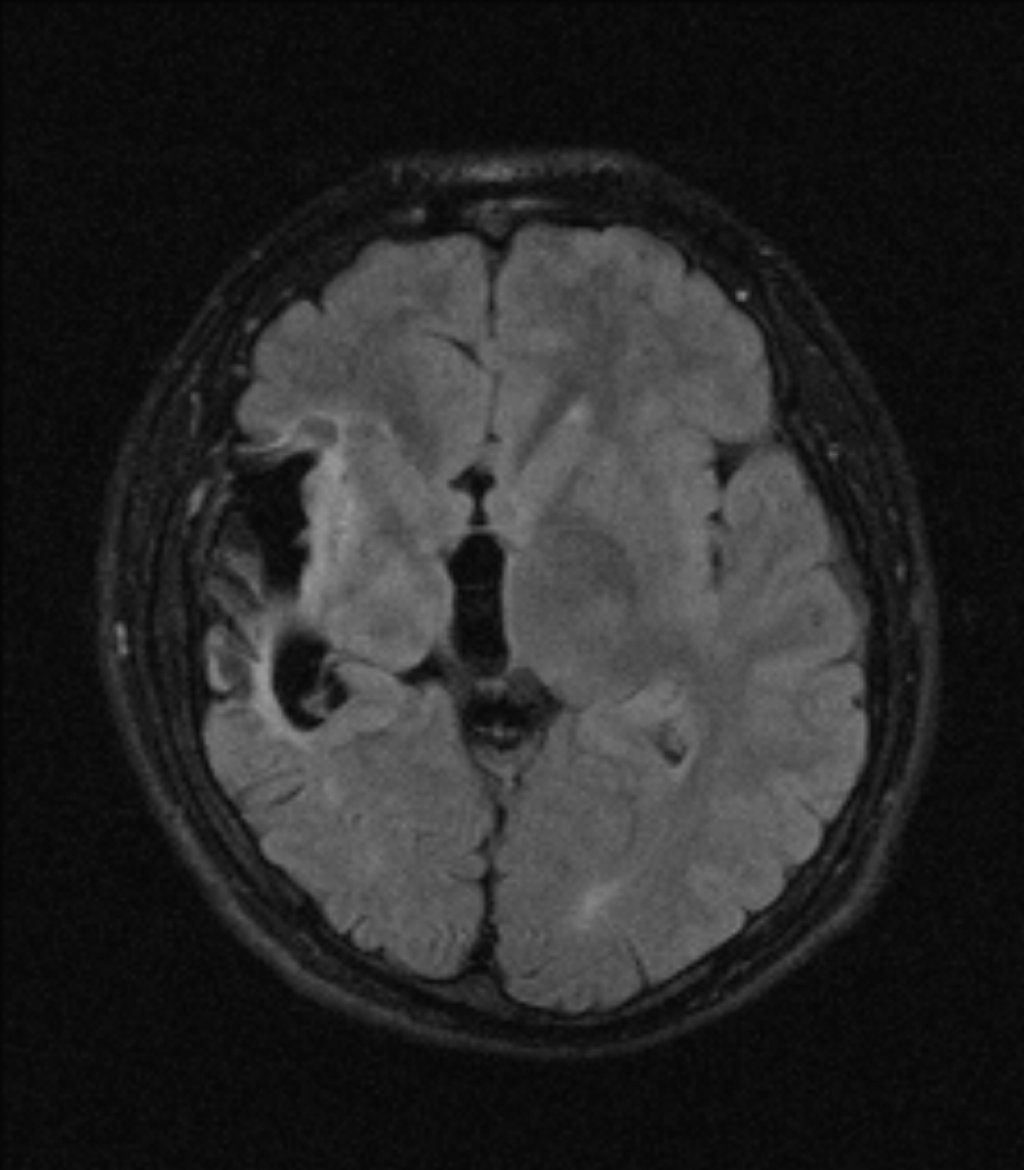 Церебральная гемиатрофия (Dyke–Davidoff–Masson syndrome)