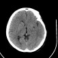 Ишемический инсульт головного мозга Ишемический инсульт головного мозга