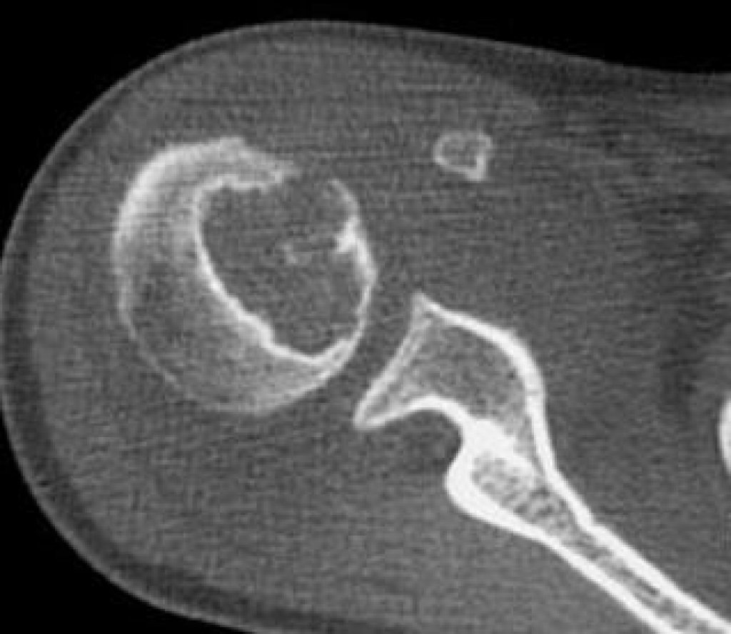 хондросаркома