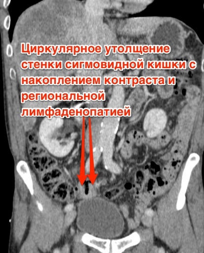 Утолщение стенки сигмовидной кишки на мрт