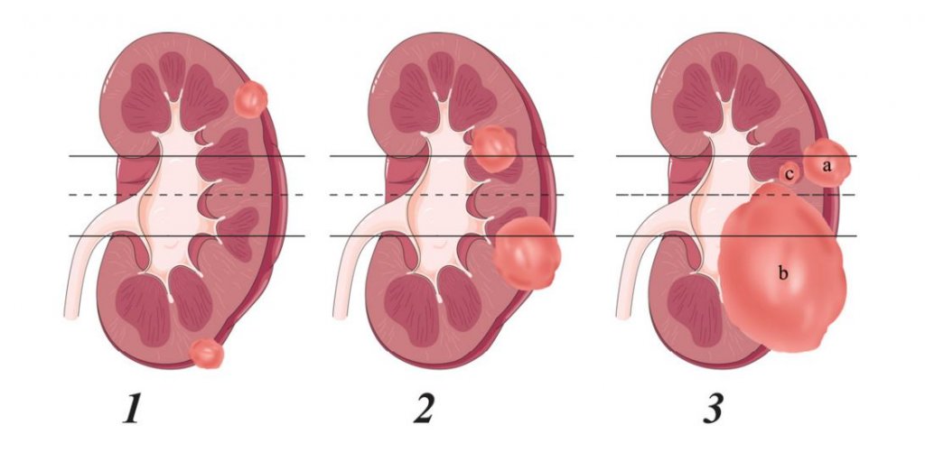 R e n a l. Шкала Ренал нефрометрическая. Шкала renal для резекции почки. R.E.N.A.L шкала. Шкала Нефрометрии renal.