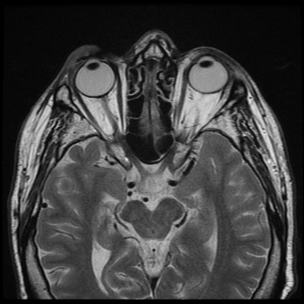 Плоскоклеточная карцинома верхнего века (Squamous cell carcinoma of the upper eyelid)