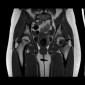 Перелом кости Эпифизиолиз головки бедренной кости