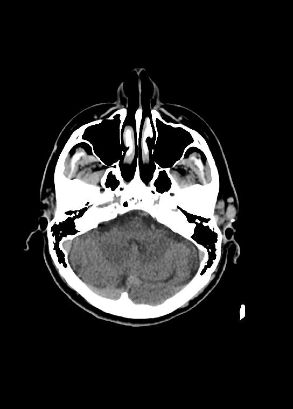 Epicranial Arteriovenous Fistula. Травматическая АВ-фистула височной области. Epicranial Arteriovenous Fistula. Травматическая АВ-фистула височной области.