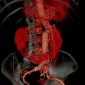 Аневризма аорты Разрыв аневризмы брюшной аорты с забрюшинной гематомой, подковообразная почка.