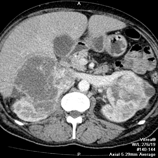 Диагностика онкоцитомы почки на снимках МРТ и КТ брюшной полости