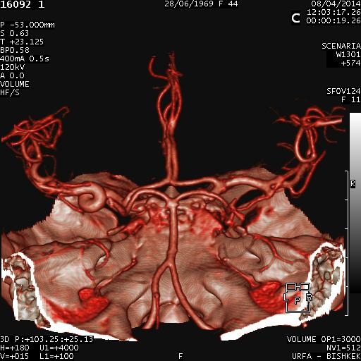 Койлинг М1 сегмента левой средней мозговой артерии 