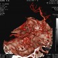 Патологическая деформация и аномалии магистральных артерий Койлинг М1 сегмента левой средней мозговой артерии 