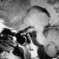 Картина буквы тау на МРТ Персистирующая (примитивная) тригеминальная артерия