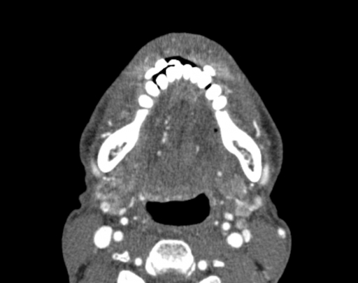 Рак глотки (ретромолярное пространство справа, контактная деструкция нижней челюсти). Постлучевые изменения. 1 балл по Hermans