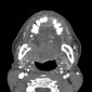Посттерапевтические изображения рака головы и шеи Рак глотки (ретромолярное пространство справа, контактная деструкция нижней челюсти). Постлучевые изменения. 1 балл по Hermans