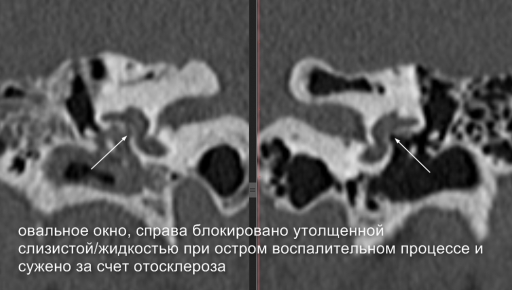 Fenestralnyj Otoskleroz Radiografiya