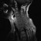 Сирингомиелия Сирингомиелия шейно-грудного отдела спинного мозга