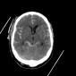 Аневризма сосудов головного мозга Нетравматическое cубарахноидальное кровоизлияние при разрыве мешотчатой аневризмы правой внутренней сонной артерии