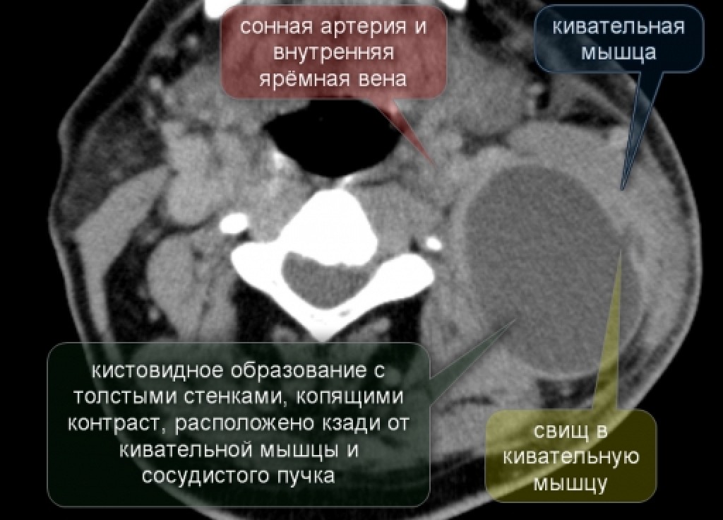 Инфицированная киста 3 жаберной дуги, осложненная абсцессом кивательной мышцы