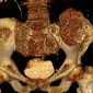Энхондрома Вторичная хондросаркома костей таза