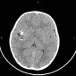 Аневризма сосудов головного мозга Частично тромбированная аневризма М2-М3 правой среднемозговой артерии