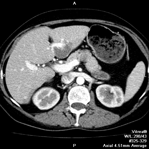 Гемангиома Печени Фото — New-Freepik.Ru