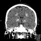 Кальцинаты в головном мозге Кальцификация структур головного мозга при послеоперационном гипопаратиреозе