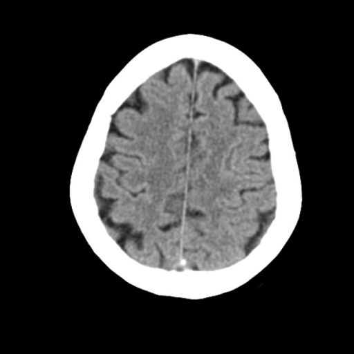 Тромбоз верхнего сагиттального, поперечного синуса твердой мозговой оболочки справа