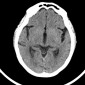 Гипоплазия / аплазия поперечного / сигмовидного синуса Тромбоз верхнего сагиттального, поперечного синуса твердой мозговой оболочки справа