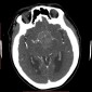 Аневризма сосудов головного мозга Тромбированая аневризма. Cубарахноидальное и интравентрикулярное кровоизлияние.